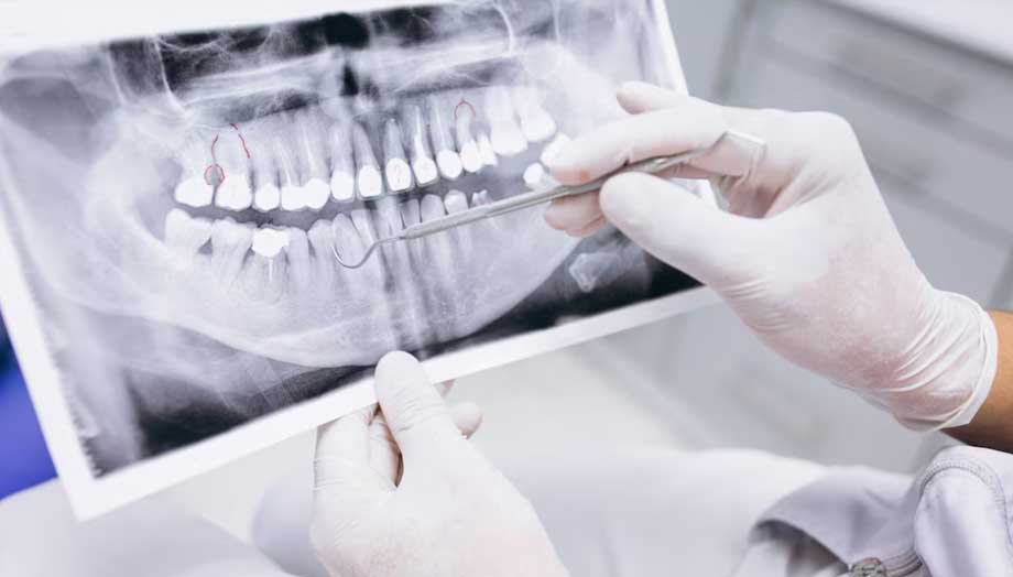 Dentista revisando radiografia para examinar donde poner implantes dentales