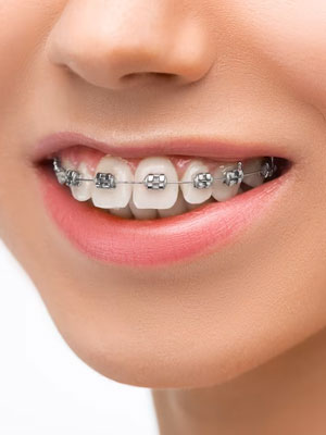 Diseño de sonrisa con ortodoncia
