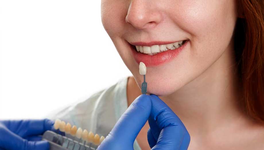 dentista probando carillas dentales en la sonrisa de una mujer