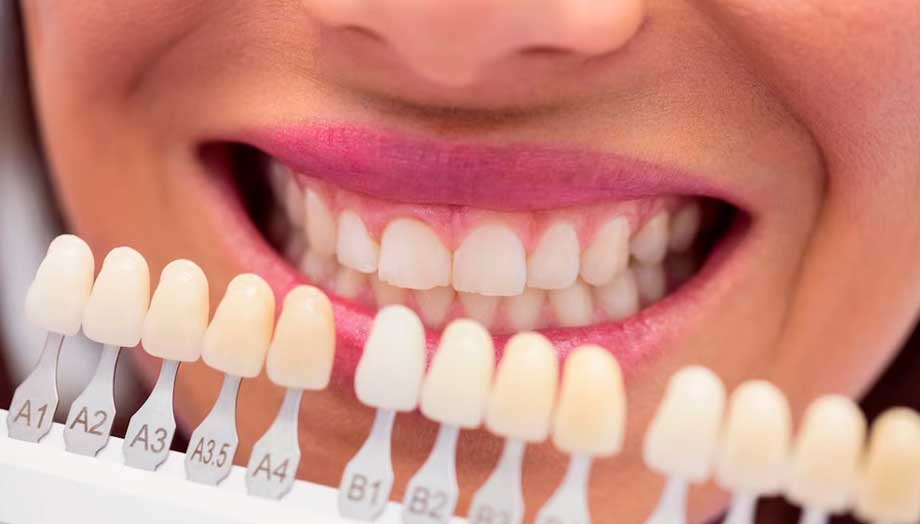 Muestra de carillas dentales frente a los dientes de una mujer